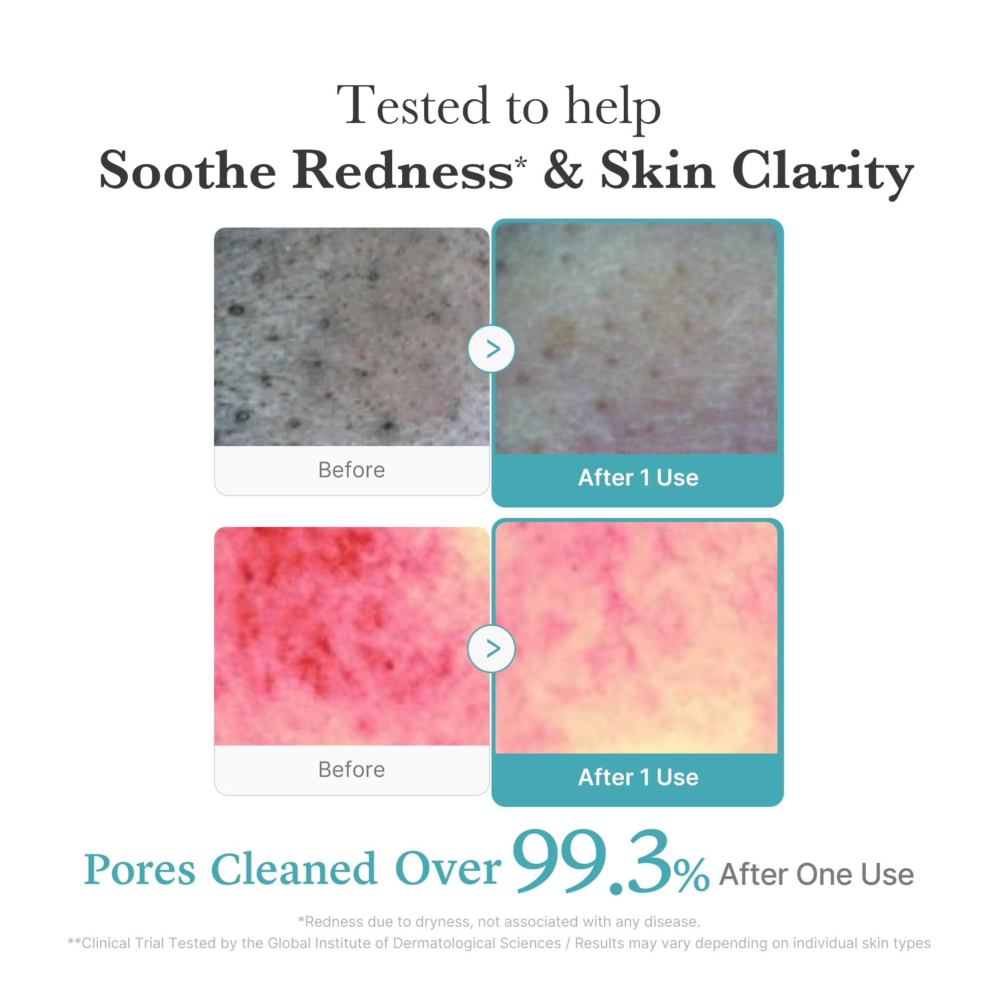 Medicube Azelaic Acid Whip Cleanser – Soothing Foaming Cleanser for Troubled Skin | Niacinamide & Glycerin | Korean Skincare 4.23 oz
